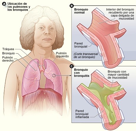 La bronquiolitis afecta sobre todo a los menores de un año y se cura mayormente en dos semanas